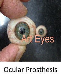 Ocular Prosthesis delhi india
